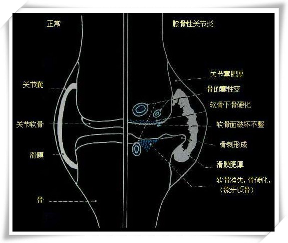 膝关节炎疼痛用什么中草药,老年退化性膝关节炎怎么治疗