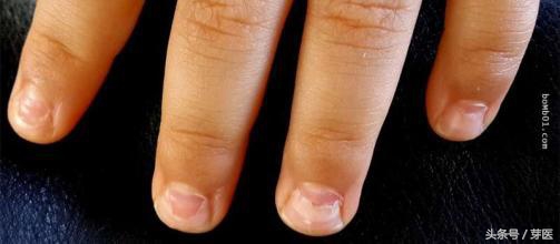 “手足口”后指甲掉了！宝妈们，别慌