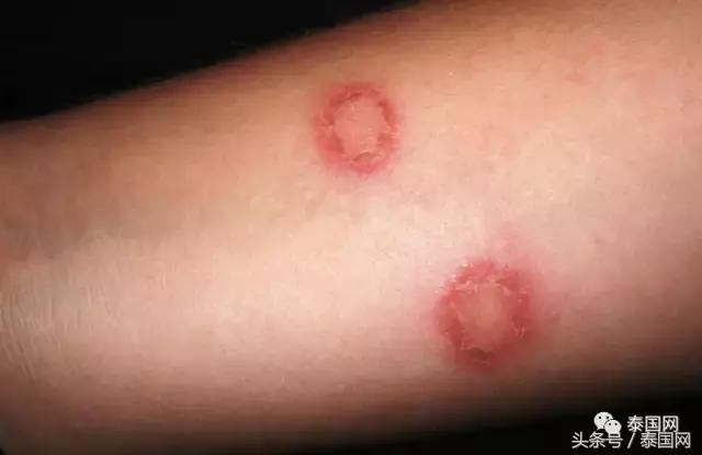 狂欢归狂欢，宋干节一定要小心这5种疾病！