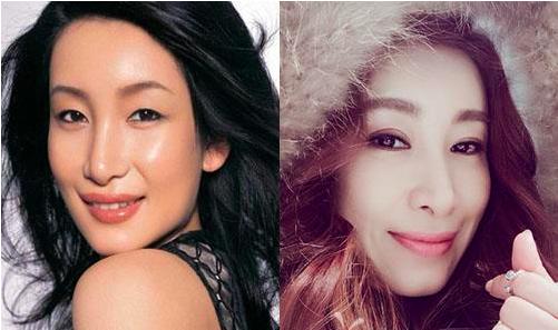 给自己点耐心：双眼皮术后一定要有一段恢复期！