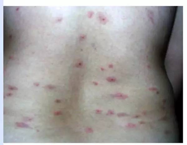 回老家身上长红疙瘩怎么回事很痒,五岁小孩身上起红疙瘩很痒怎么办