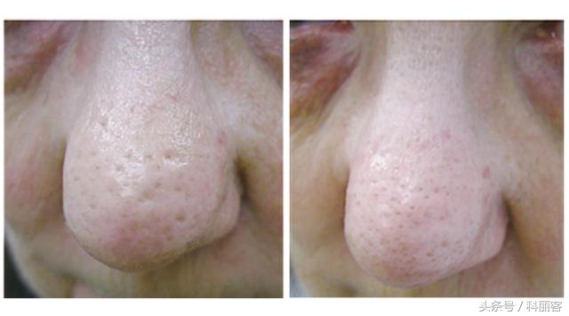 改善毛孔粗大最简单有效的方法,如何有效改善毛孔粗大的方法