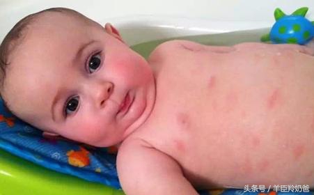 宝宝湿疹反复发作怎么办,为什么会导致宝宝湿疹反反复复