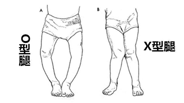 如何判断小宝宝有罗圈腿o型腿,孩子o型腿的原因