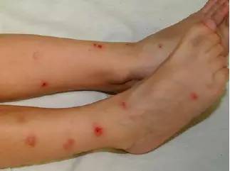 回老家身上长红疙瘩怎么回事很痒,五岁小孩身上起红疙瘩很痒怎么办