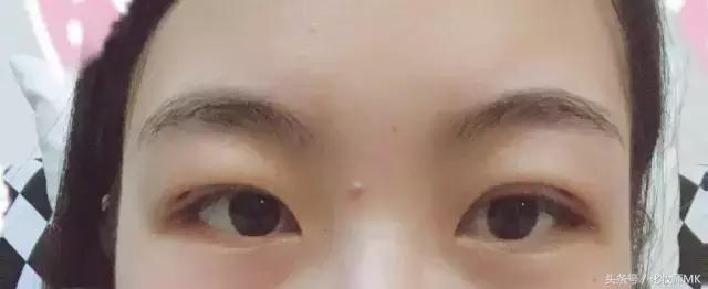 真实贴双眼皮贴,单眼皮怎么贴第二天变双眼皮