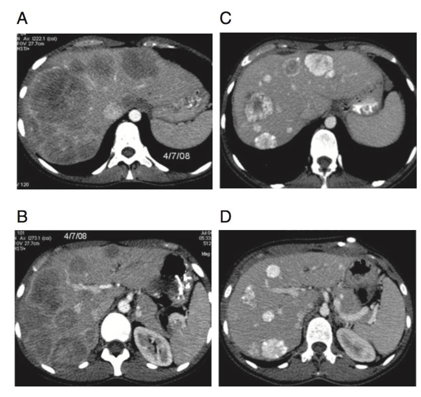 已经肝转移化疗还有救吗,海扶刀治疗肝转移瘤效果好吗