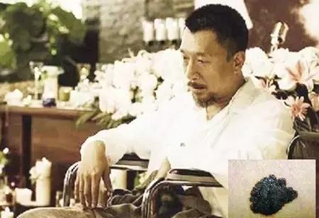 做胃镜怀疑癌变医生让做ct,做胃镜检查疑似肿瘤