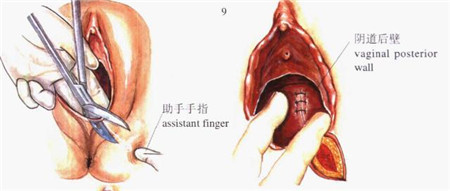 产妇顺产侧切为啥越来越痛,顺产侧切有刺痛感