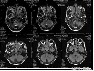 右上腹不适和眼睛发黄,右上腹不适一年多了