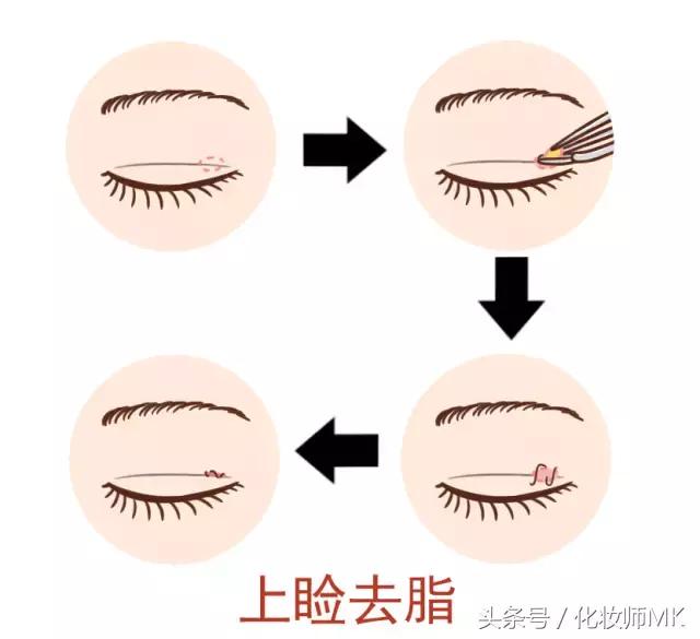 真实贴双眼皮贴,单眼皮怎么贴第二天变双眼皮