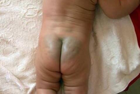 婴儿屁股后面有青痕是体寒吗,宝宝出生屁股青是妈妈宫寒吗