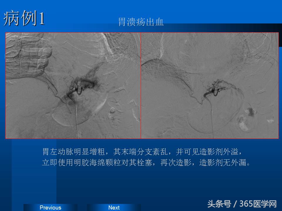 崔进国：消化道出血的介入治疗