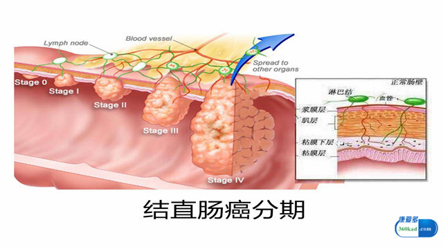 直肠癌晚期患者一般还能活多久？