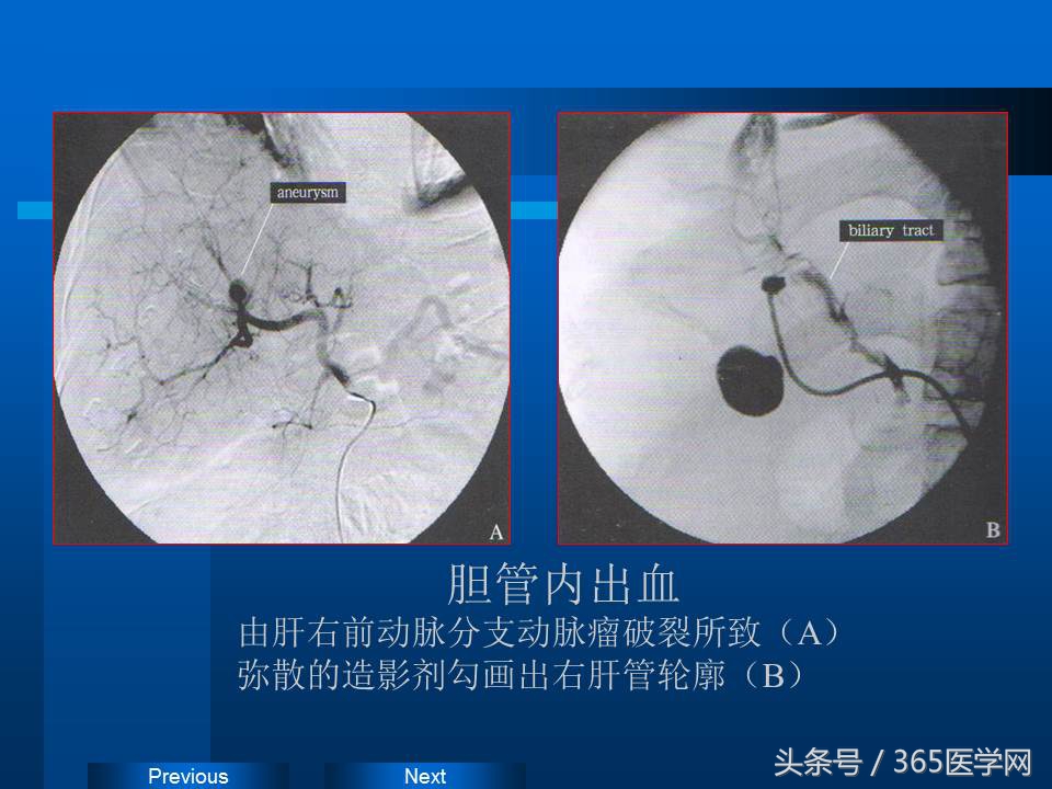 崔进国：消化道出血的介入治疗