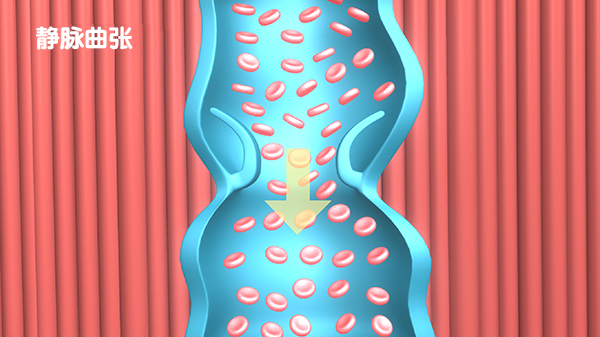 静脉曲张的病因及微创治疗方法？视频告诉你