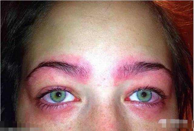 美女在家染眉毛，结果双眼肿得吓人！代价太大了！