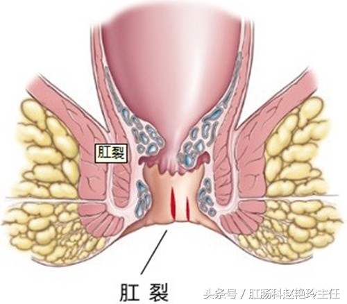 女性肛裂是什么原因造成的,女性肛裂的原因和治疗方法