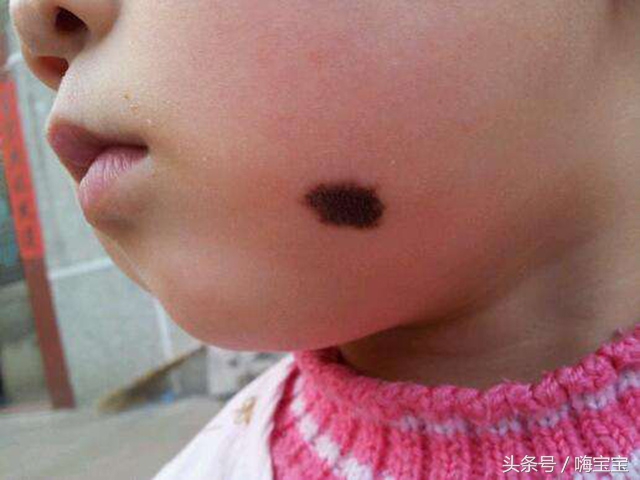 小孩皮肤胎记多,孩子身上各种颜色胎记