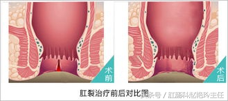 女性肛裂是什么原因造成的,女性肛裂的原因和治疗方法