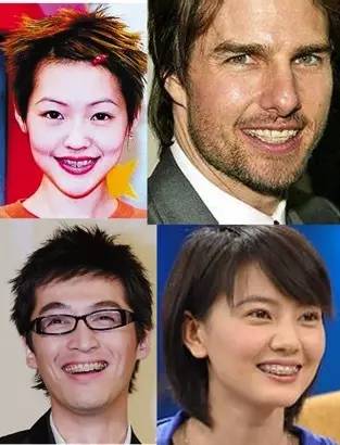 孙杨矫正牙齿前后,孙杨的牙齿是如何整形的