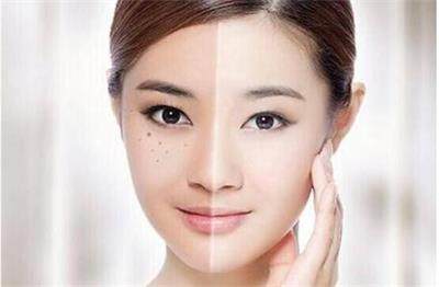 激光祛斑前你需要了解这些才能更好祛斑