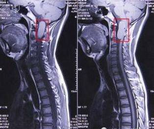 如何定位椎间盘位置,如何快速定位脊椎