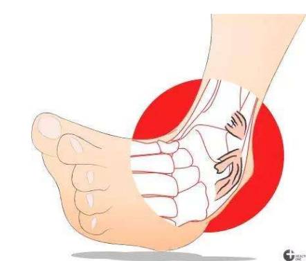 崴脚一招教你判断是不是骨折,崴脚别慌4招教你快速康复