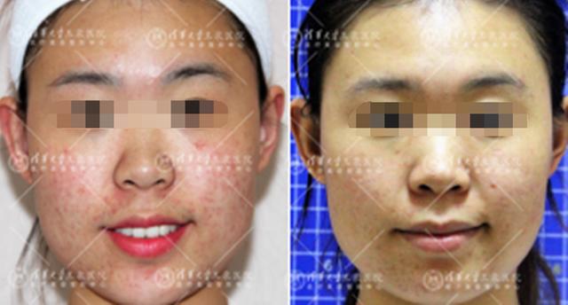 ordinary30%果酸脸上有痘痘可以用吗,果酸对脸上的痘有用吗