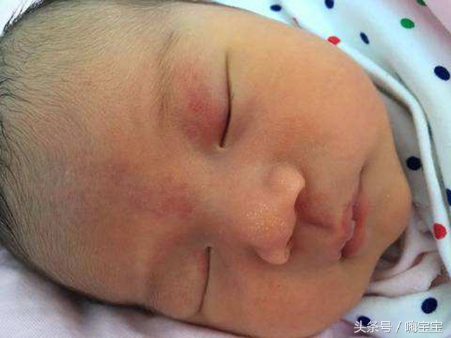 小孩皮肤胎记多,孩子身上各种颜色胎记