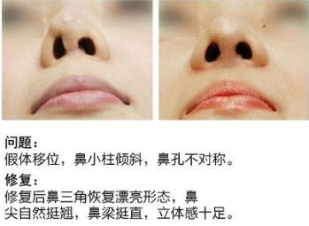 做了隆鼻手术怎么都不消肿,做隆鼻手术失败有哪些症状