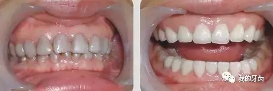 冷光美白牙齿靠谱吗,牙齿美白全过程视频