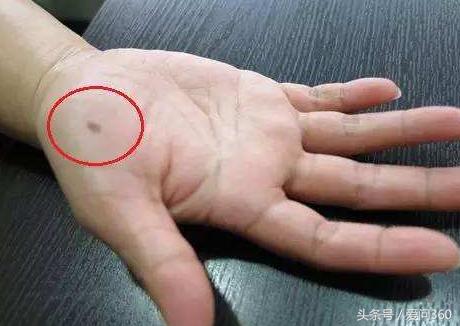 异常的痣切掉后就安全了吗,异常黑痣