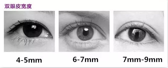 做双眼皮一个星期后感觉太宽了,第一次做双眼皮太窄了