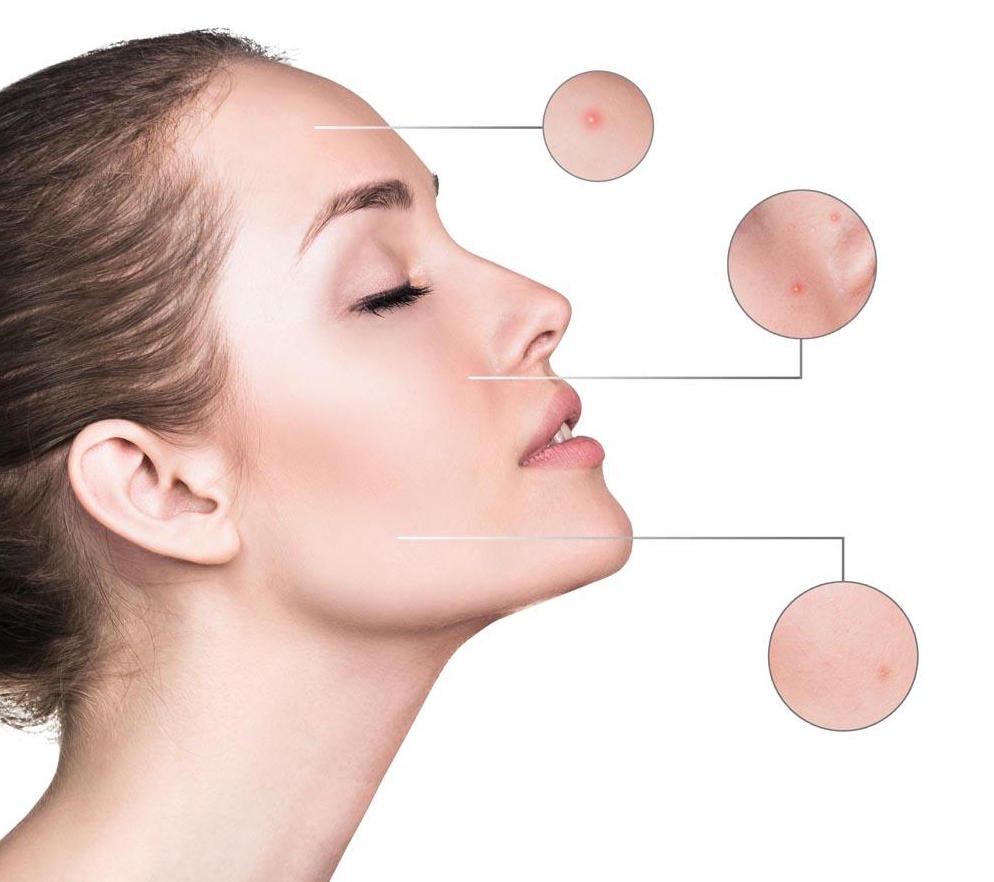脸上痘痘告诉你身体哪里出了问题,脸上起痘痘对应的是哪里有问题