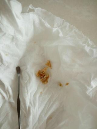 怎样才能挖到这么大块耳屎?恶心!但看着好爽啊!