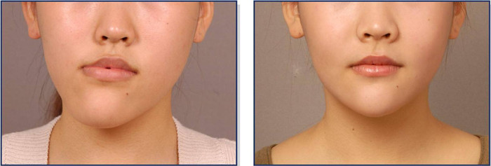 用一边牙齿吃饭脸歪了能恢复吗,长期一边吃饭脸歪