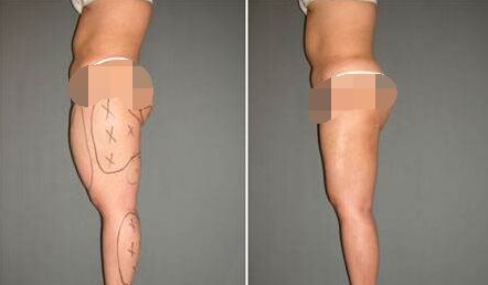 大腿抽脂后多久可以洗澡,大腿抽脂容易凹凸不平吗