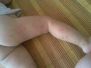 防治蚊虫叮咬的最好方法,蚊虫叮咬预防内服药物