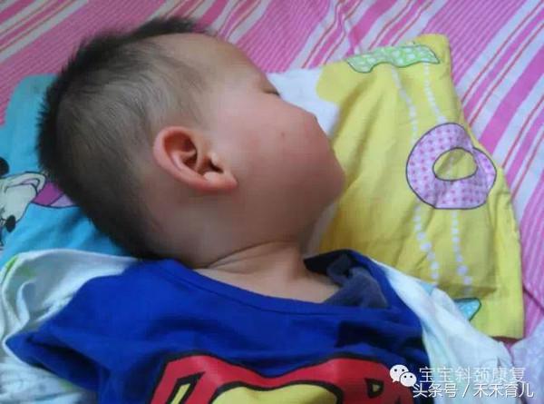 歪颈宝宝如何纠正,宝宝因为习惯导致的斜颈怎么纠正