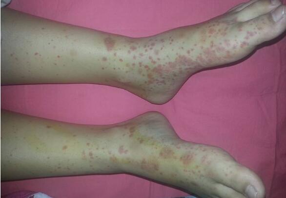 过敏性紫癜一直反复是什么原因,儿童过敏性紫癜反复发作的原因