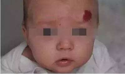 初生婴儿痣和胎记怎么区别,孩子长痣和胎记区别