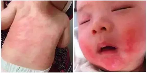 湿疹被当做热疹治疗会怎么样,痱子湿疹抹什么药膏