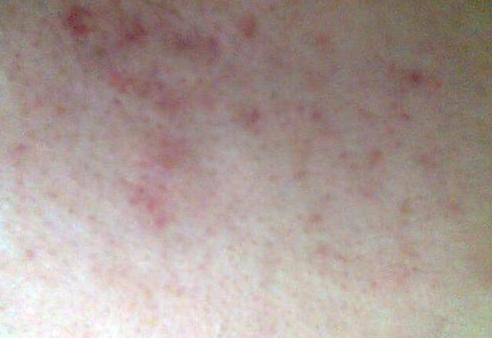 超级好用的祛痘印产品,祛痘去印神器亲测有效