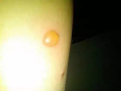 脚板磨出水泡还能继续打球吗,打球磨出水泡怎样处理