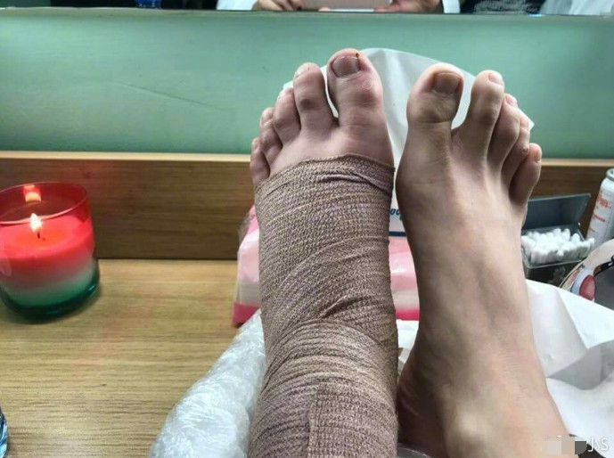 小S经过针灸2次已可慢步走路大赞中医博大精深