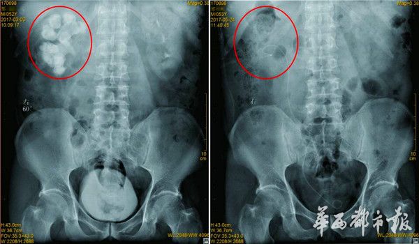 男子结石取出1200颗石头,有结石经常做体外碎石