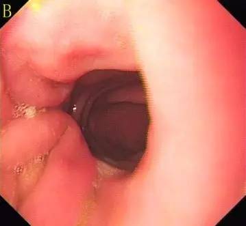 胃镜预处理流程,胃镜内镜手术全流程