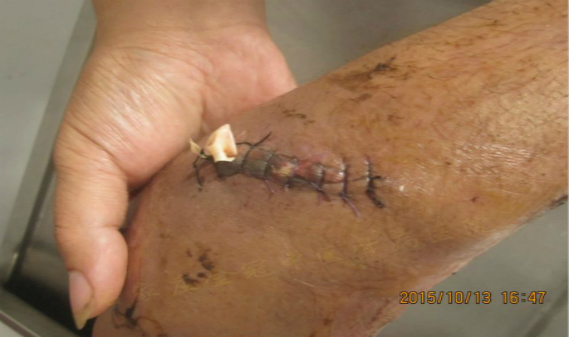 骨结核的十大忌讳,骨关节治疗的误区