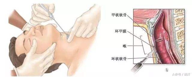 发生气道异物首选急救方法,气道异物抢救措施